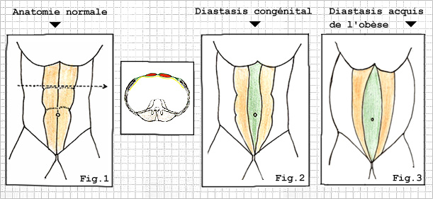 Diastasis, hernie ombilicale, hernie épigastrique